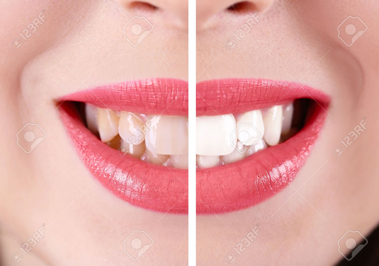 Smiling woman, teeth: before and after concept - 51811339 Smiling woman, teeth: before and after concept - 51811339