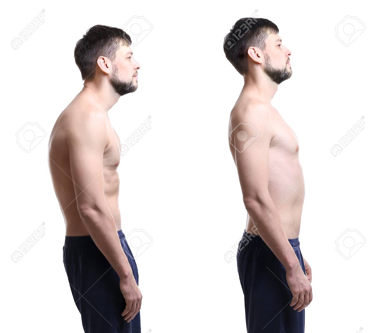 Rehabilitation Concept Collage Of Man With Poor And Good Posture On White Background Stock Photo Picture And Royalty Free Image Image 95546728
