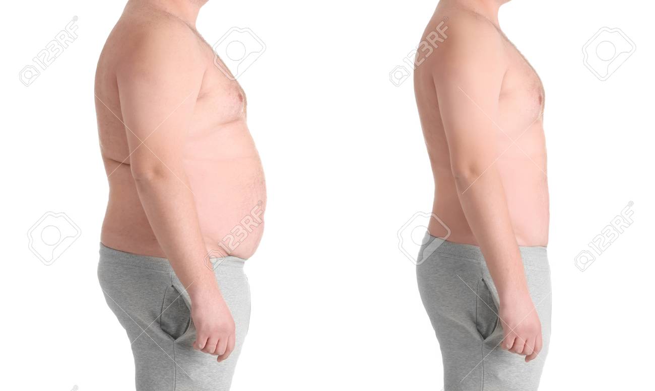 Nasenseptumoperation vor und nach Gewichtsverlust