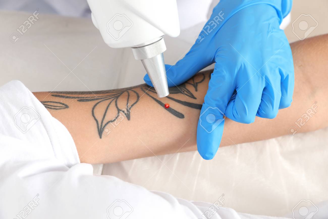 Woman undergoing laser tattoo removal procedure in salon, closeup - 110000031 Woman undergoing laser tattoo removal procedure in salon, closeup - 110000031