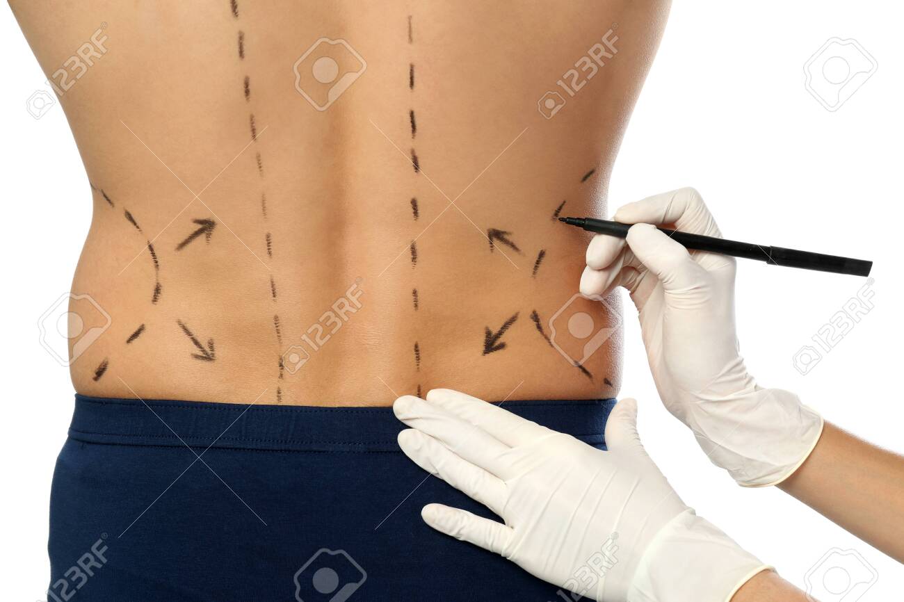 Doctor drawing marks on man's body for cosmetic surgery operation against white background, closeup - 127034444 Doctor drawing marks on man's body for cosmetic surgery operation against white background, closeup - 127034444