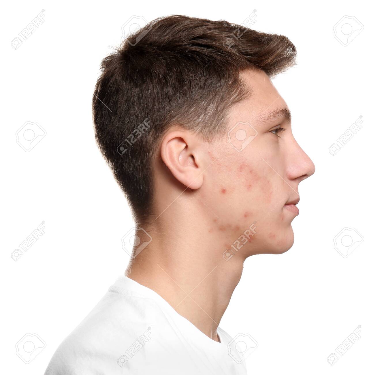 guy with acne