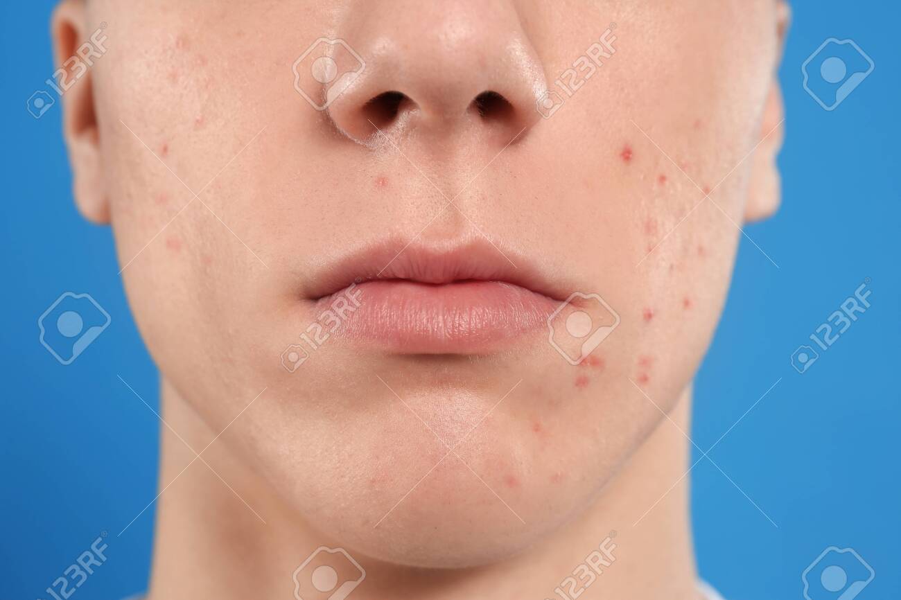 guy with acne