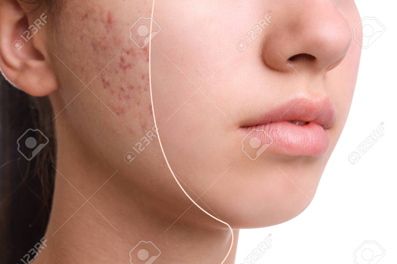 Teenage girl before and after acne treatment on white background, closeup - 138446955 Teenage girl before and after acne treatment on white background, closeup - 138446955