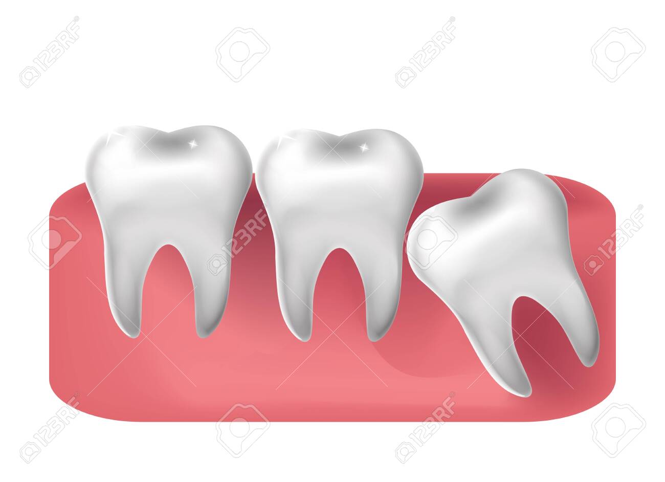 Wisdom tooth cut through, 3d realistic style. Dentistry, wisdom teeth extraction concept. Vector illustration. - 149023717 Wisdom tooth cut through, 3d realistic style. Dentistry, wisdom teeth extraction concept. Vector illustration. - 149023717