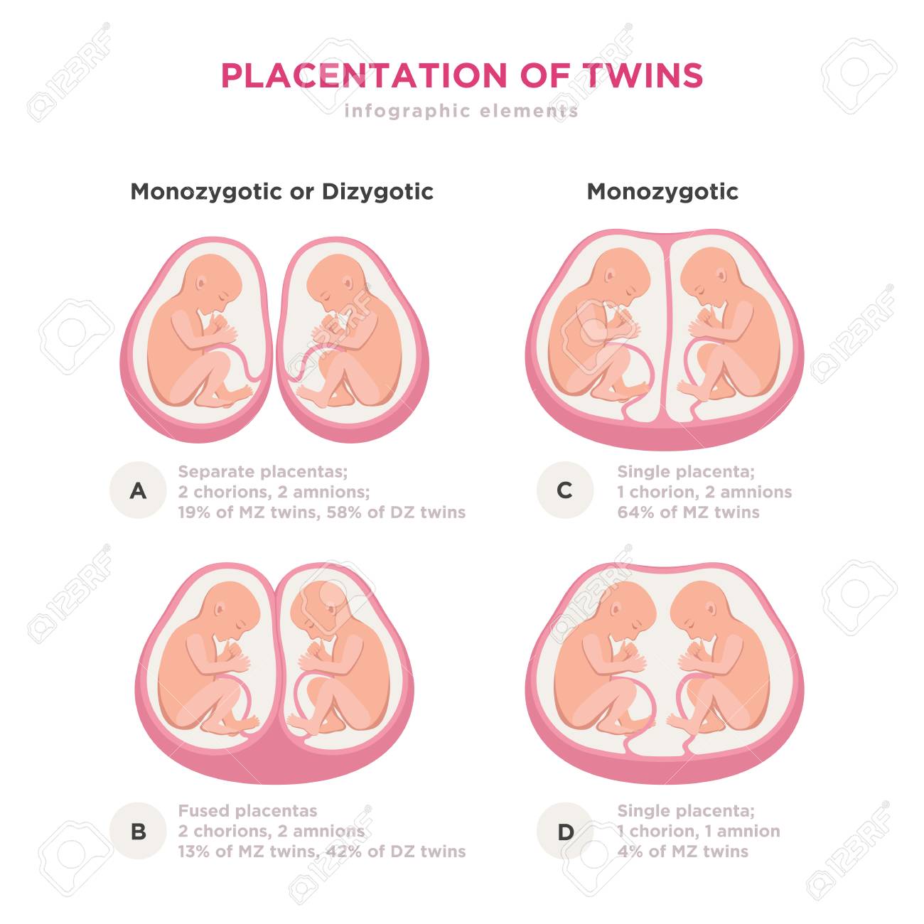 107665823-twin-types-infographic-elements-in-flat-design-monozygotic-or-dizygotic-placentation-of-twins-medica.jpg