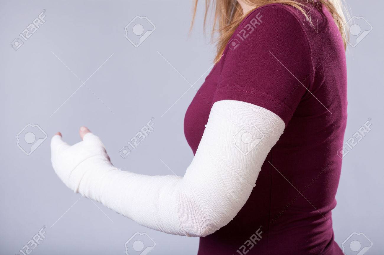 骨折した腕を持つ若い女の子のクローズ アップ の写真素材 画像素材 Image