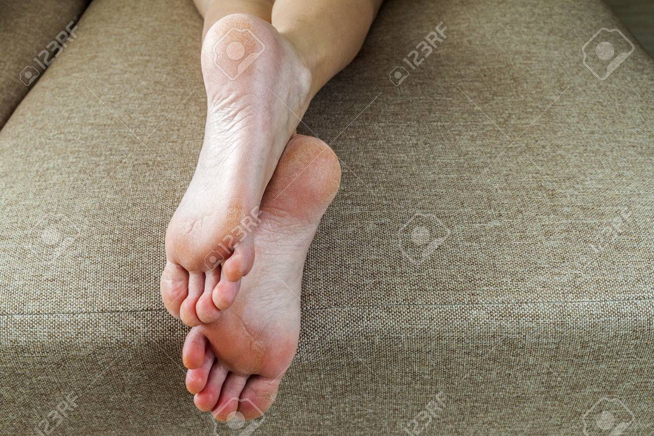 Dry cracked skin on feet