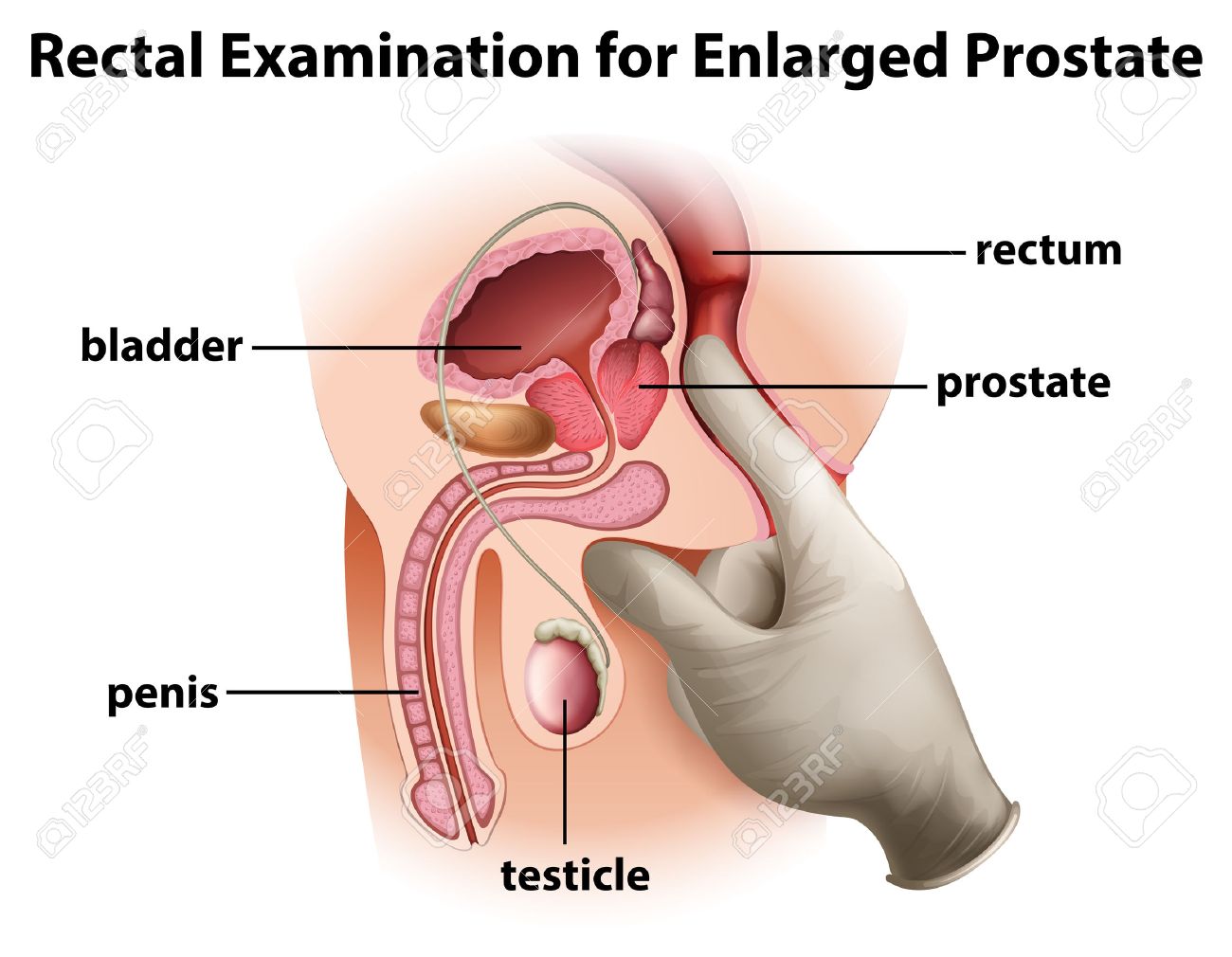 glándula prostática agrandada icd 10 glándula prostática agrandada icd 10