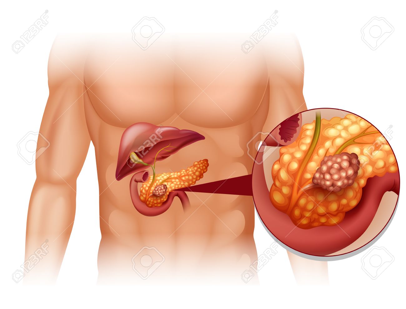 Pancreas Cancer In Human Body Illustration Royalty Free Svg Cliparts Vectors And Stock Illustration Image