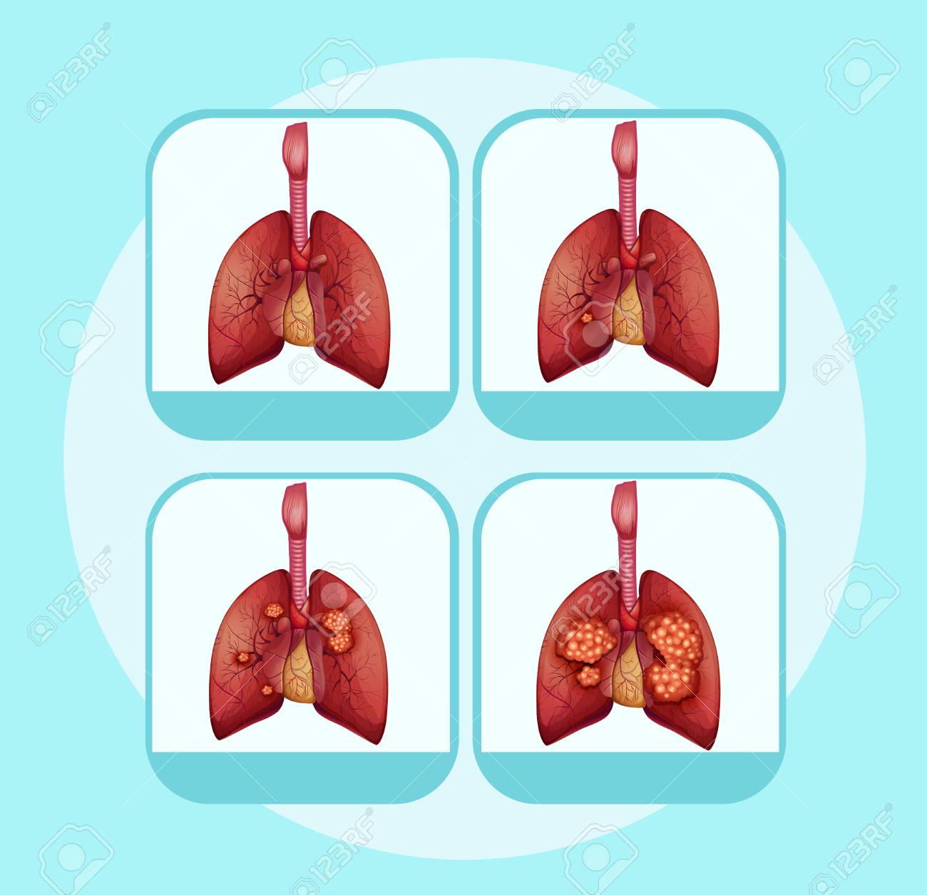Diagram Showing Different Stages Of Lung Cancer Illustration Royalty Free Cliparts Vectors And Stock Illustration Image 96927029