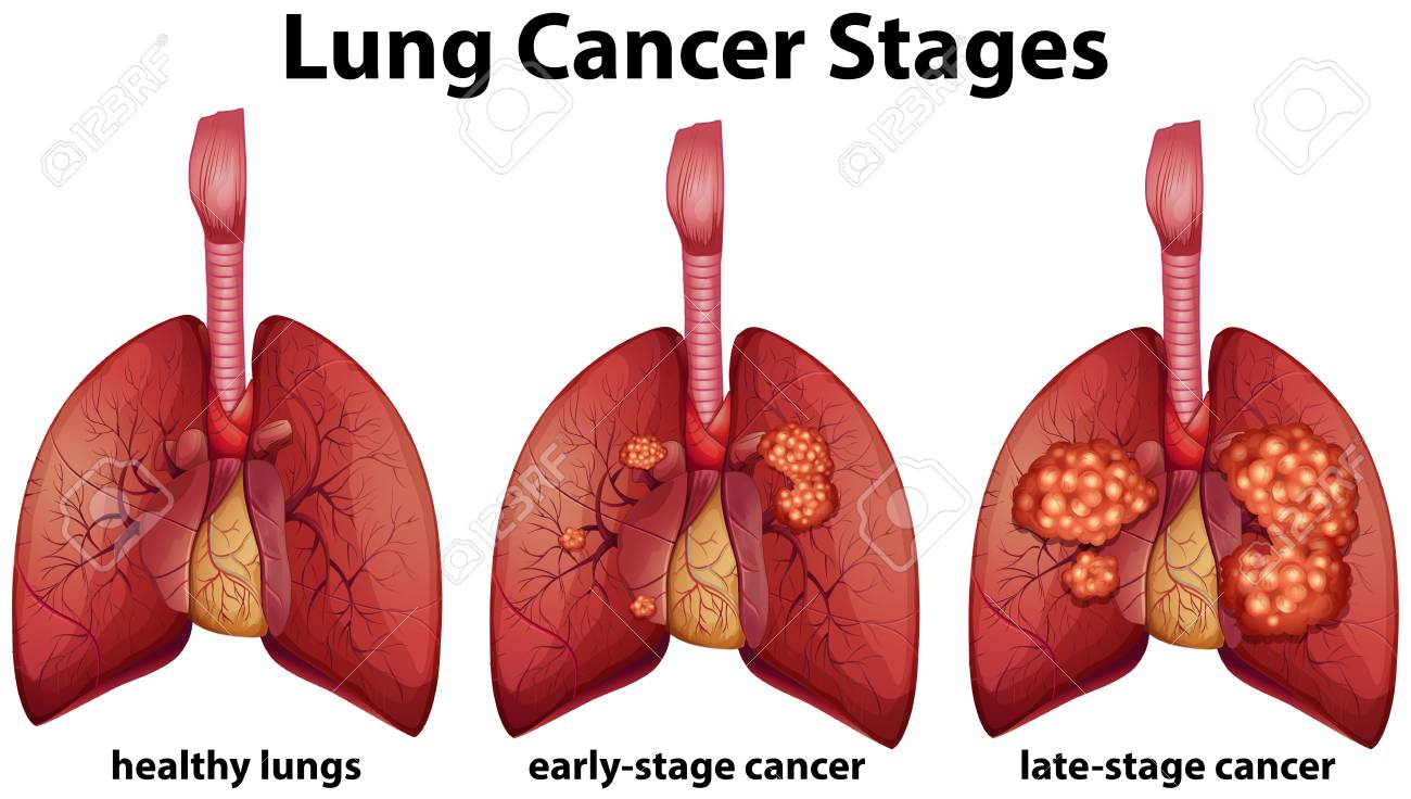 Diagram showing lung cancer stages illustration - 96927669 Diagram showing lung cancer stages illustration - 96927669