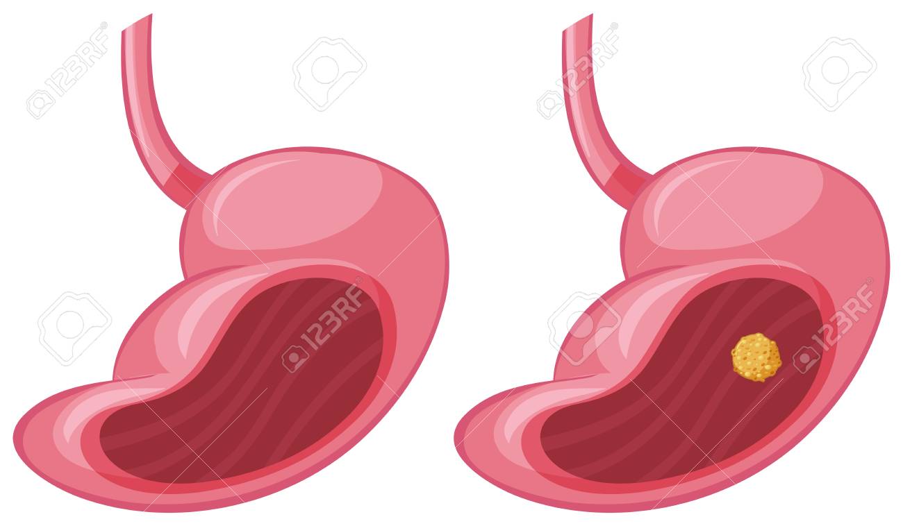 人間の胃と癌のイラスト のイラスト素材 ベクタ Image