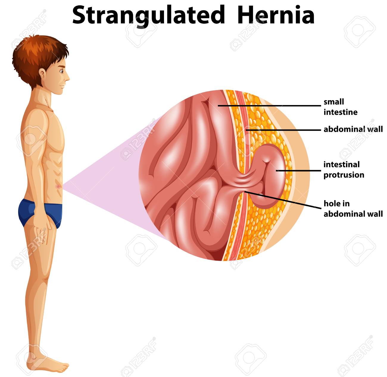 A Human Anatomy Strangulated Hernia illustration - 102799516 A Human Anatomy Strangulated Hernia illustration - 102799516