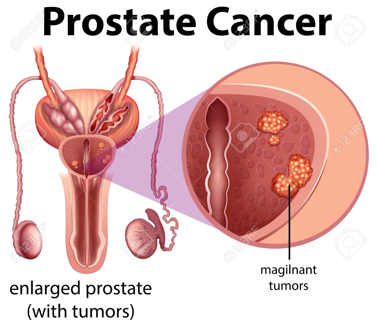 male prostate cancer diagram illustration royalty free cliparts