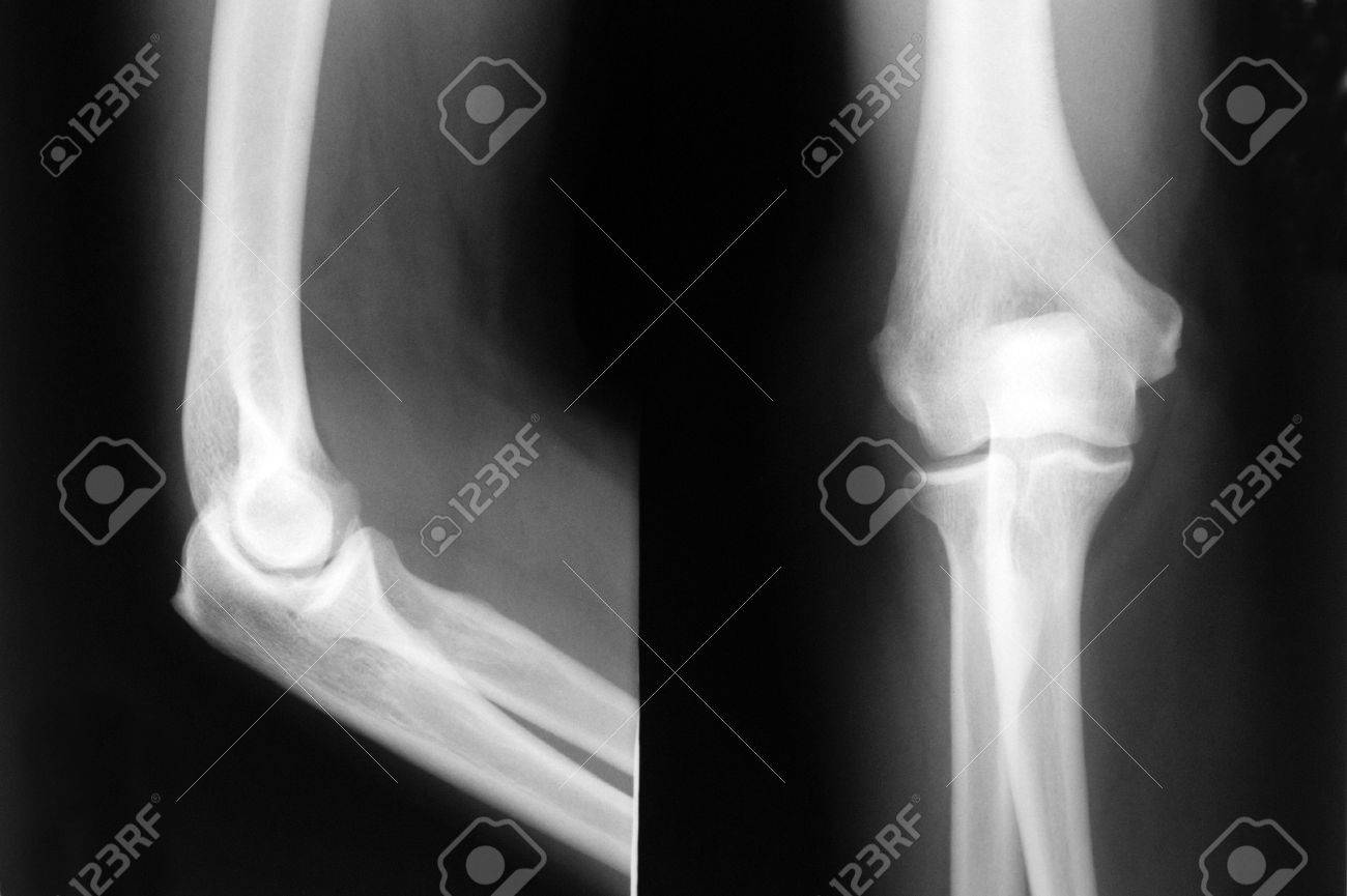 elbow xray elbow xray