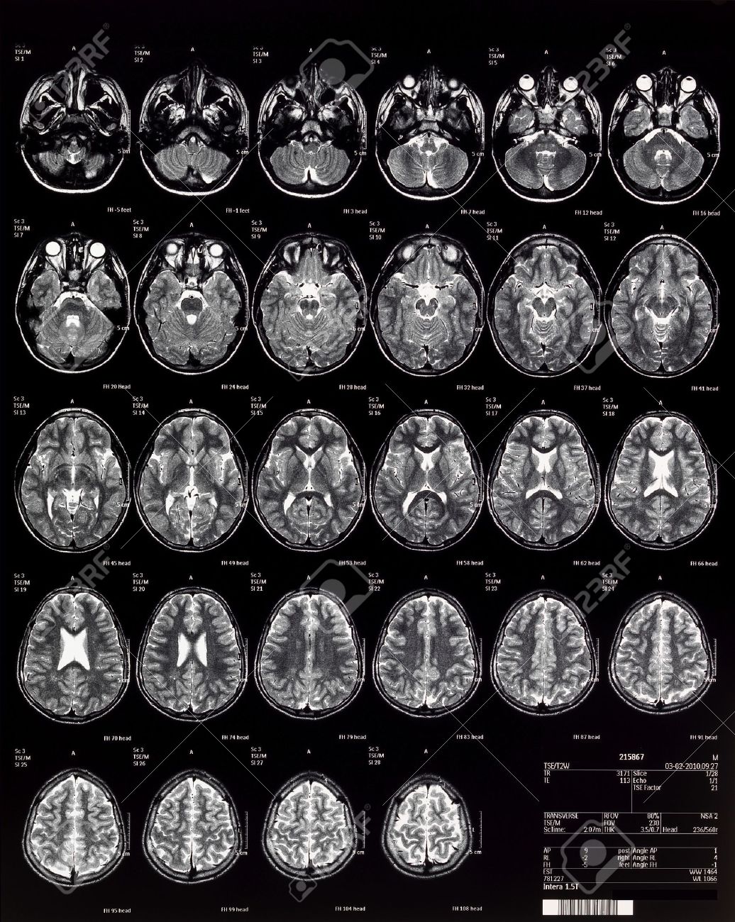 Мрт головы причины. Прогрессирующая мультифокальная лейкоэнцефалопатия кт. Мрт мозга. Кт томограмма головного мозга. Мрт головы причины.