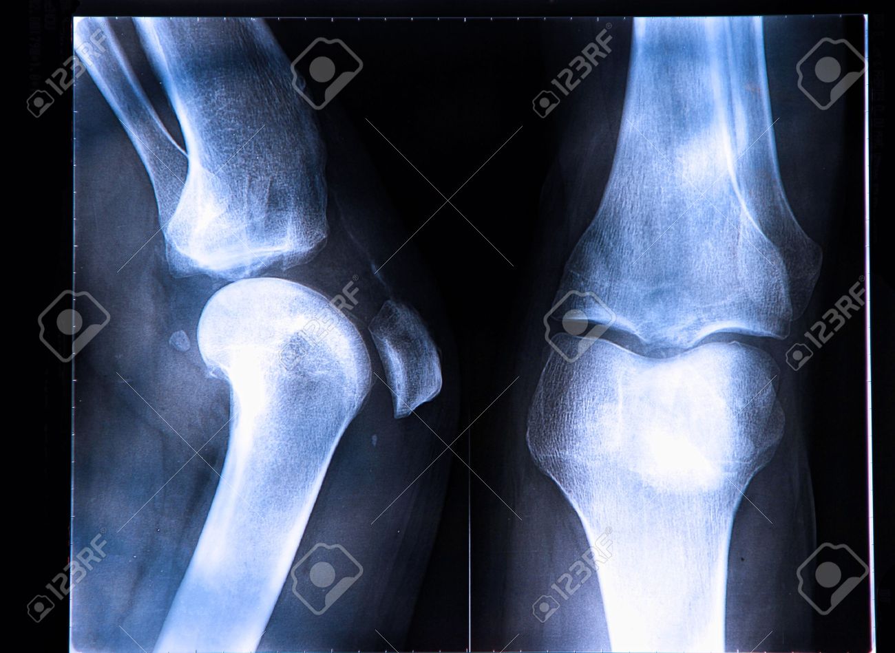 разрыв связок голеностопа рентген. рентген кости. разрыв передней крестообразной связки у собаки рентген. разрыв связок виден на рентгене. разрыв связок голеностопа рентген.