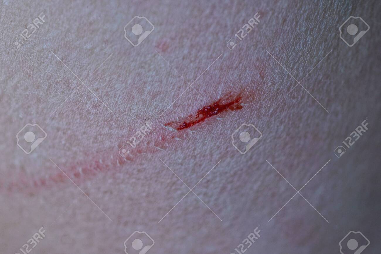 red long scratch cut on gray skin of hand - 131552160 red long scratch cut on gray skin of hand - 131552160