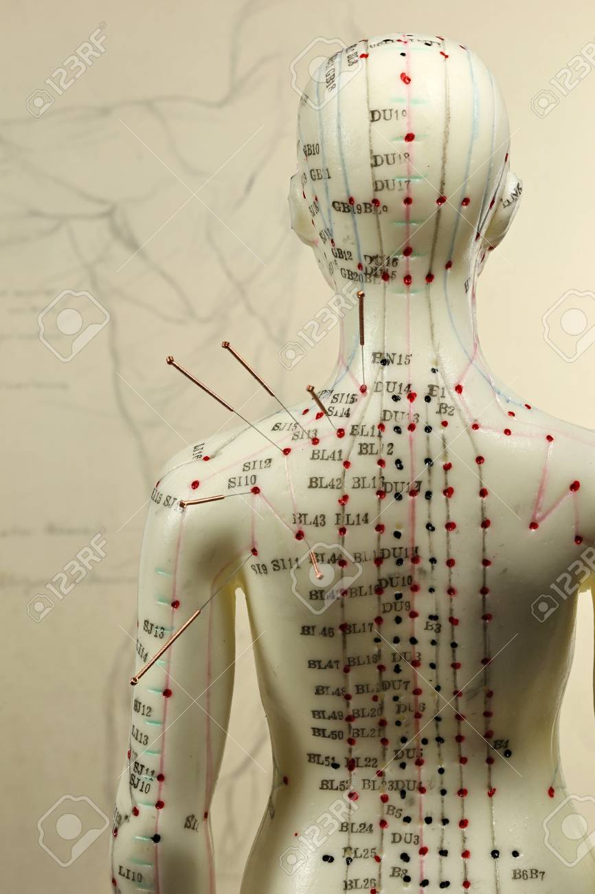 female acupuncture model with needles in the shoulder - 89904043 female acupuncture model with needles in the shoulder - 89904043