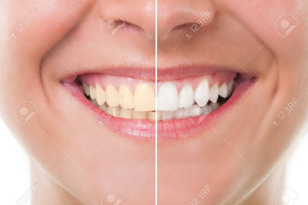 Perfect woman smile before and after whitening. Dental care and periodic exam concept - 37833246 Perfect woman smile before and after whitening. Dental care and periodic exam concept - 37833246