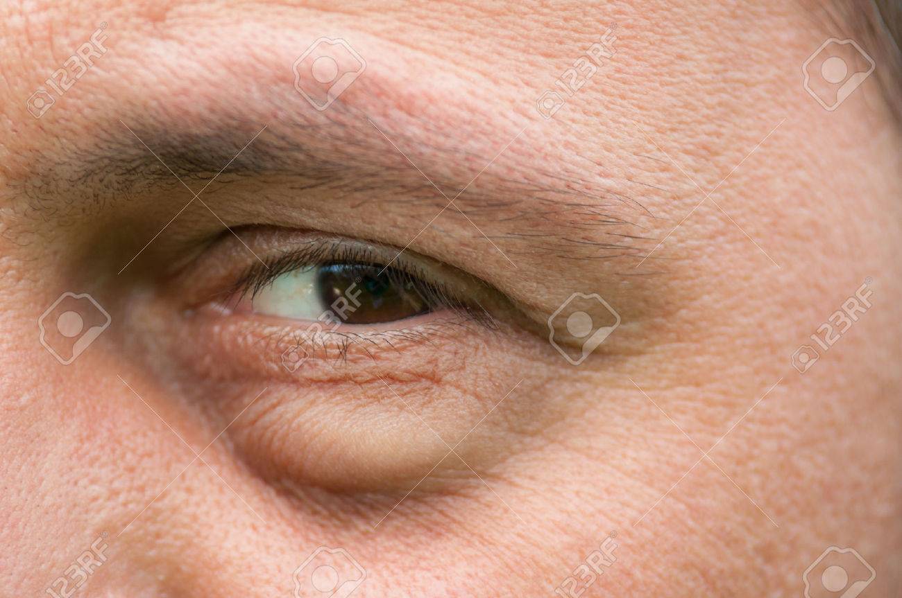 Eyesore, inflammation or bag swelling under eye. Medical problem like conjunctivitis - 41724581 Eyesore, inflammation or bag swelling under eye. Medical problem like conjunctivitis - 41724581