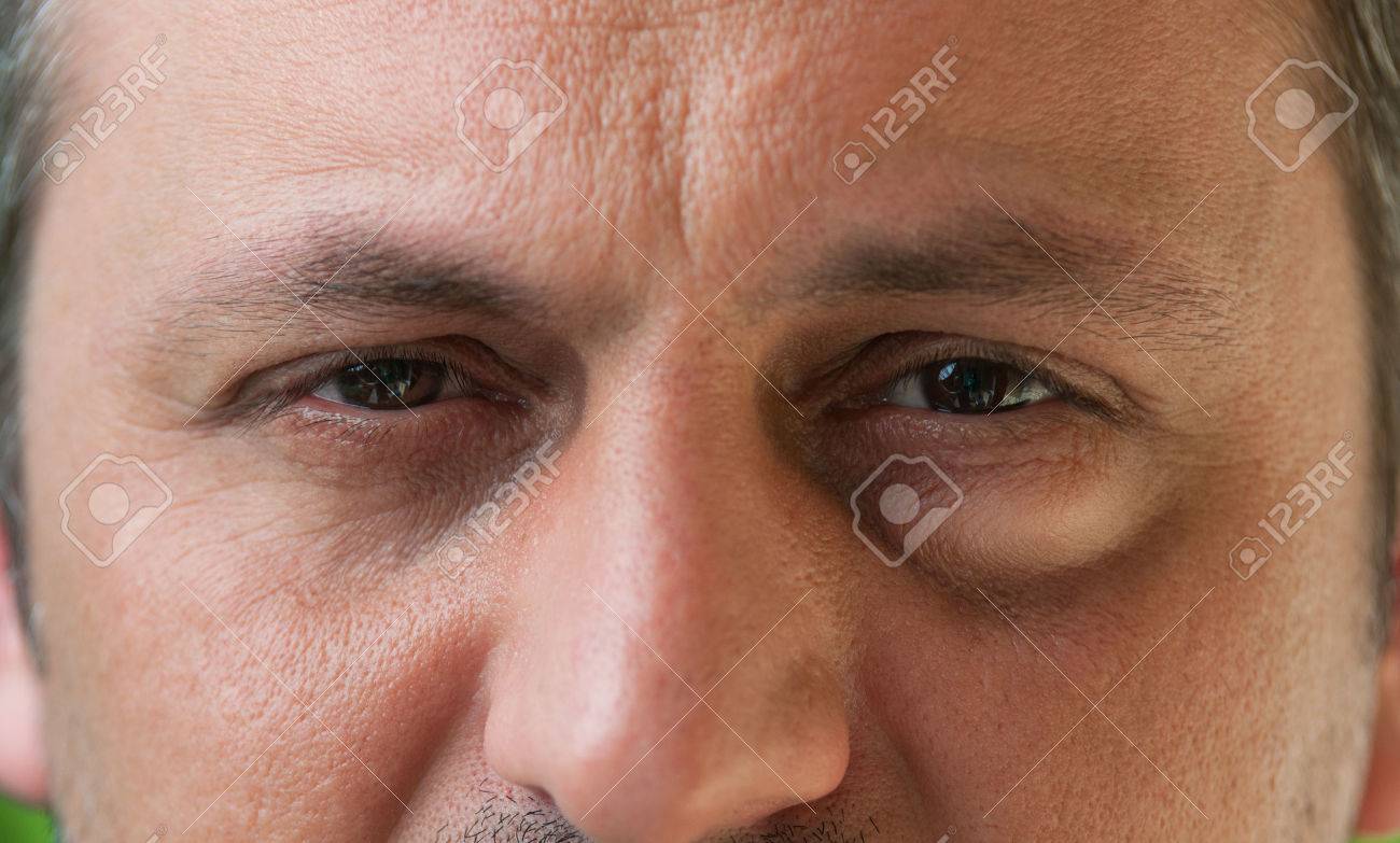 Man or male having one eye with conjunctivitis. Eyesore as medical condition - 41219396 Man or male having one eye with conjunctivitis. Eyesore as medical condition - 41219396