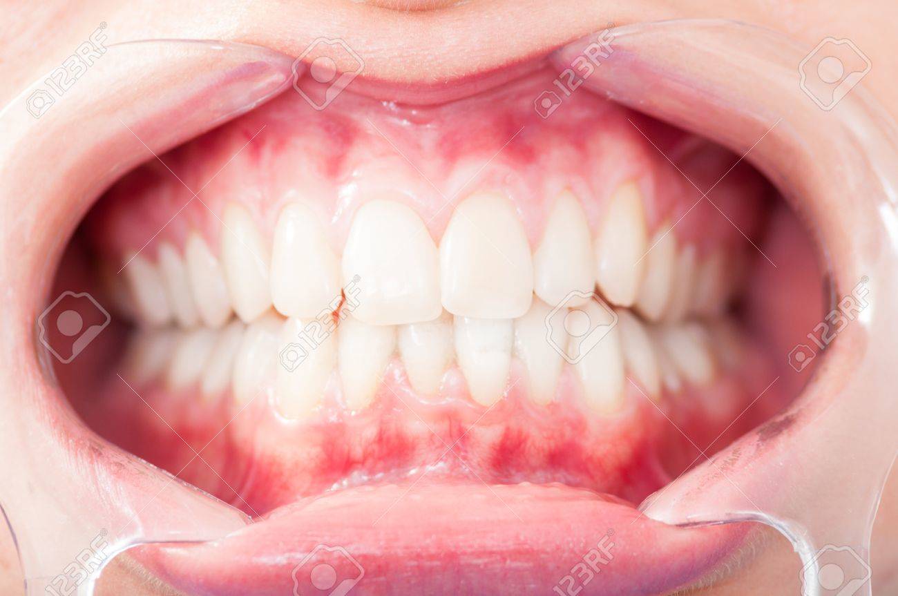 Immagini Stock Primo Piano Della Cavita Donna Protetto Da Divaricatore Mostrando I Denti Perfetti Image