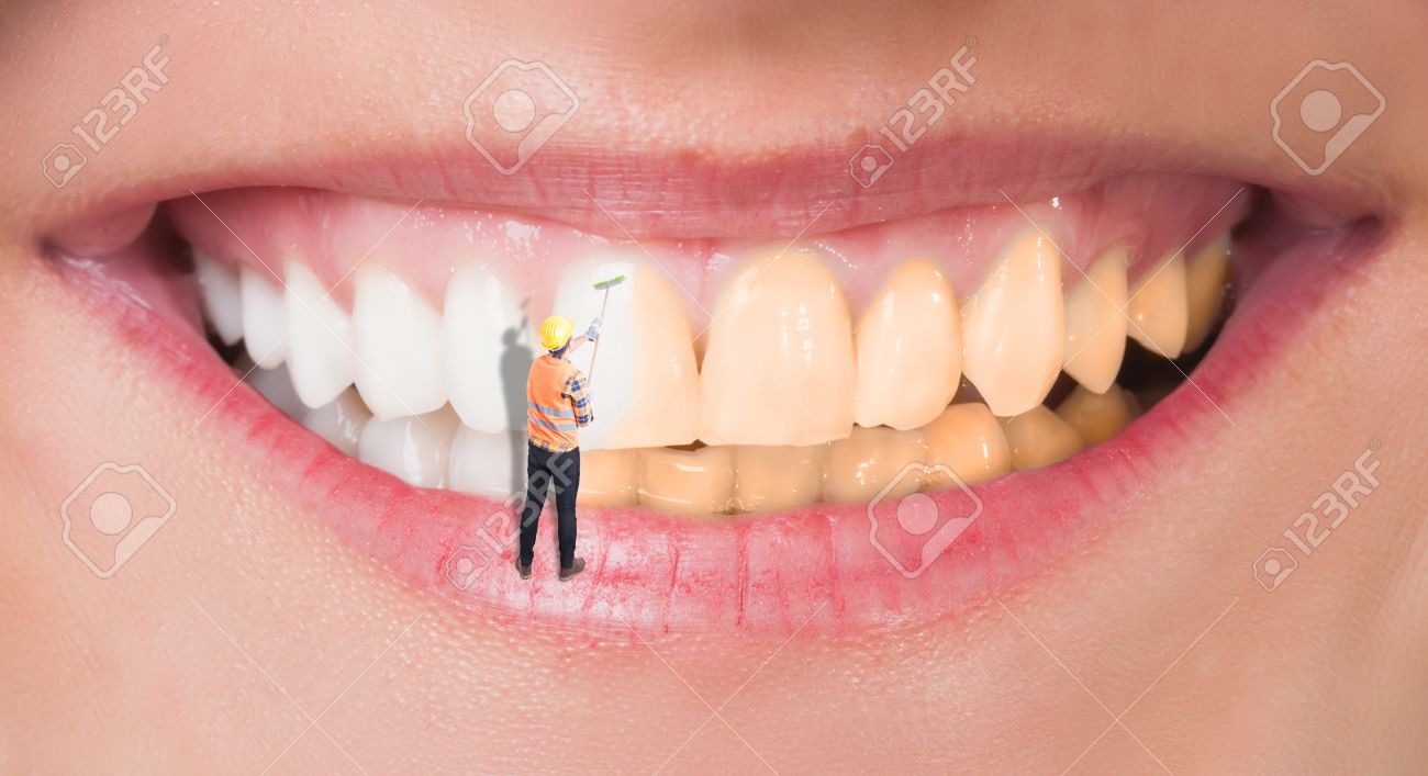 Close-up of perfect smile before and after bleaching as dental whitening concept - 57187132 Close-up of perfect smile before and after bleaching as dental whitening concept - 57187132