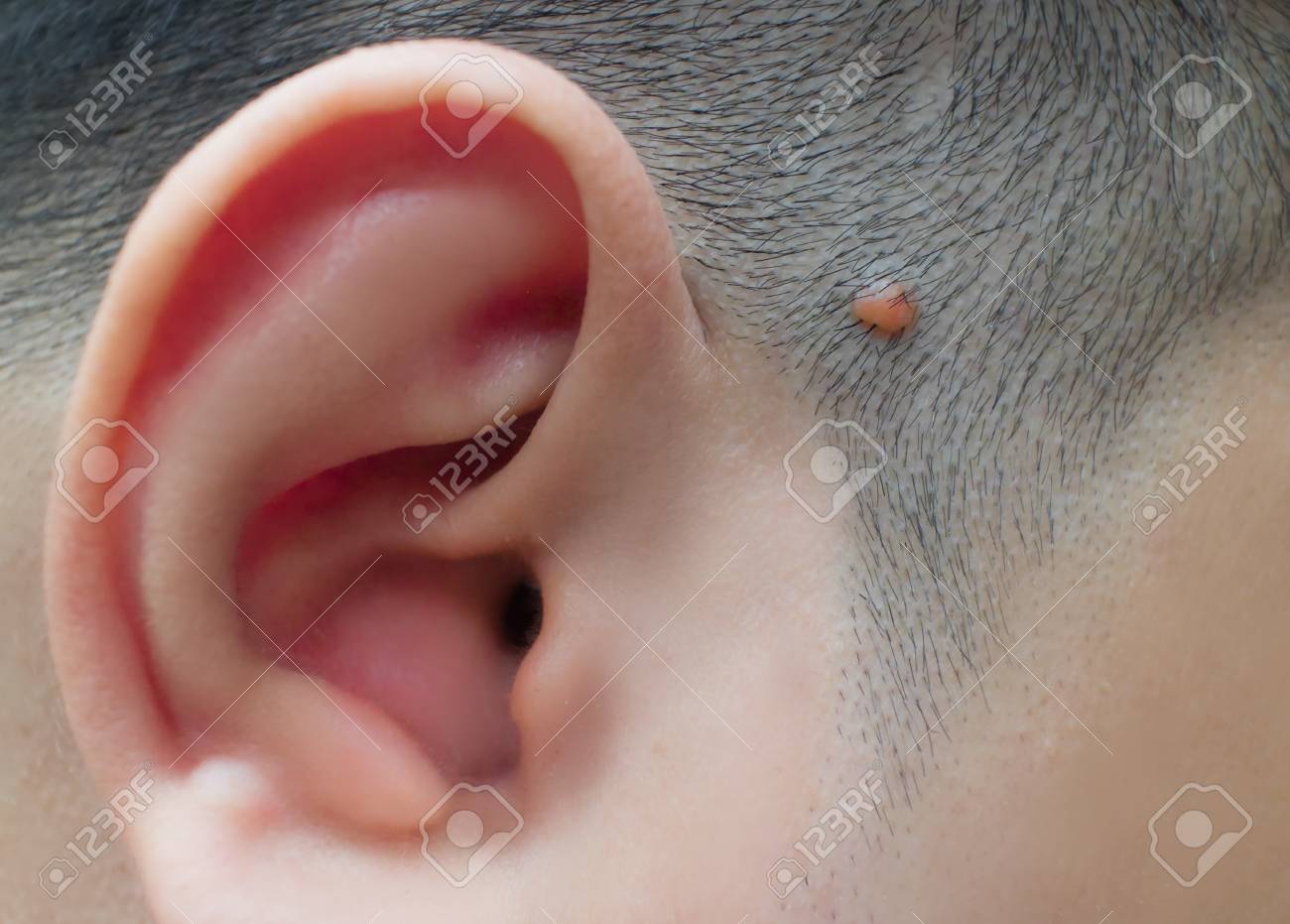 asian man with acrochordon