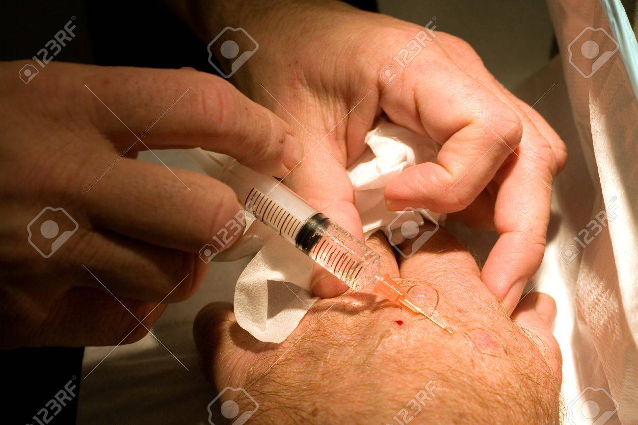 局所麻酔薬皮膚癌を切除する手術の前に手を注入されています の写真素材 画像素材 Image