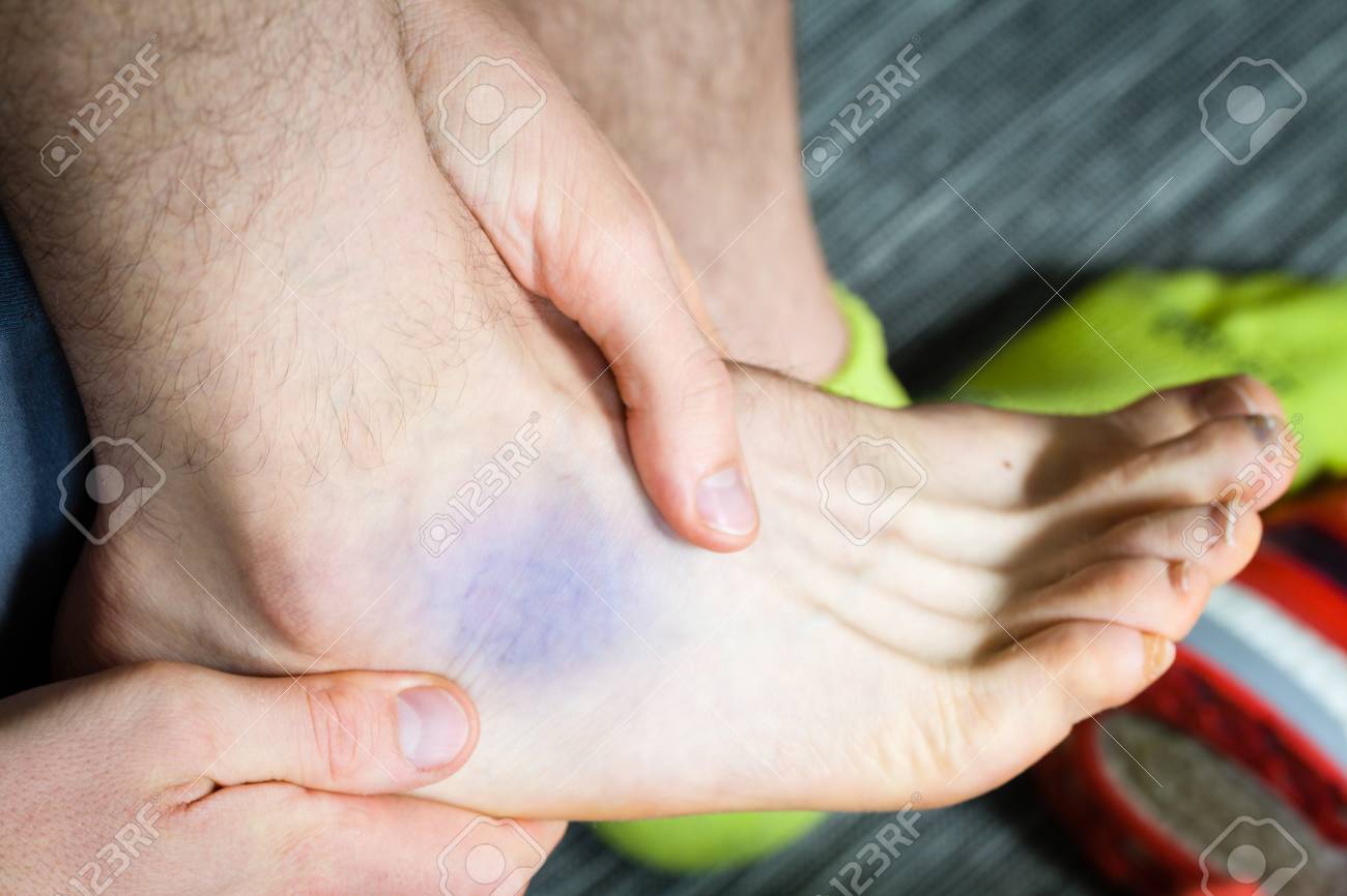 hematoma en el tobillo