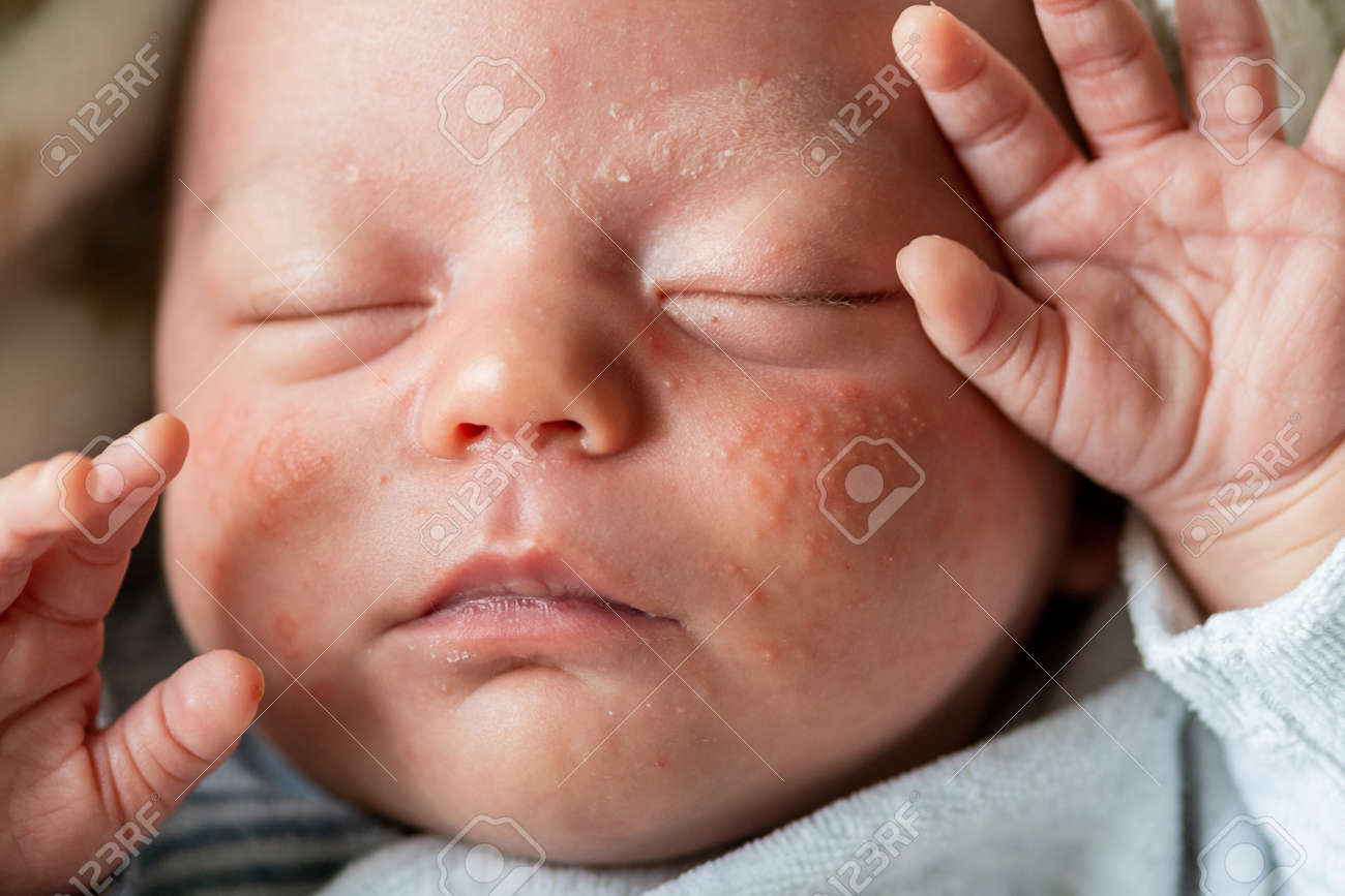 Closeup Of The Face Of A Newborn Baby With Pimples On The Cheeks Due To  Accumulation Of Keratin. Neonatal Acne, Milia, Fattening. Irritation And  Accumulation Of Pimples On The Infa Stock Photo,