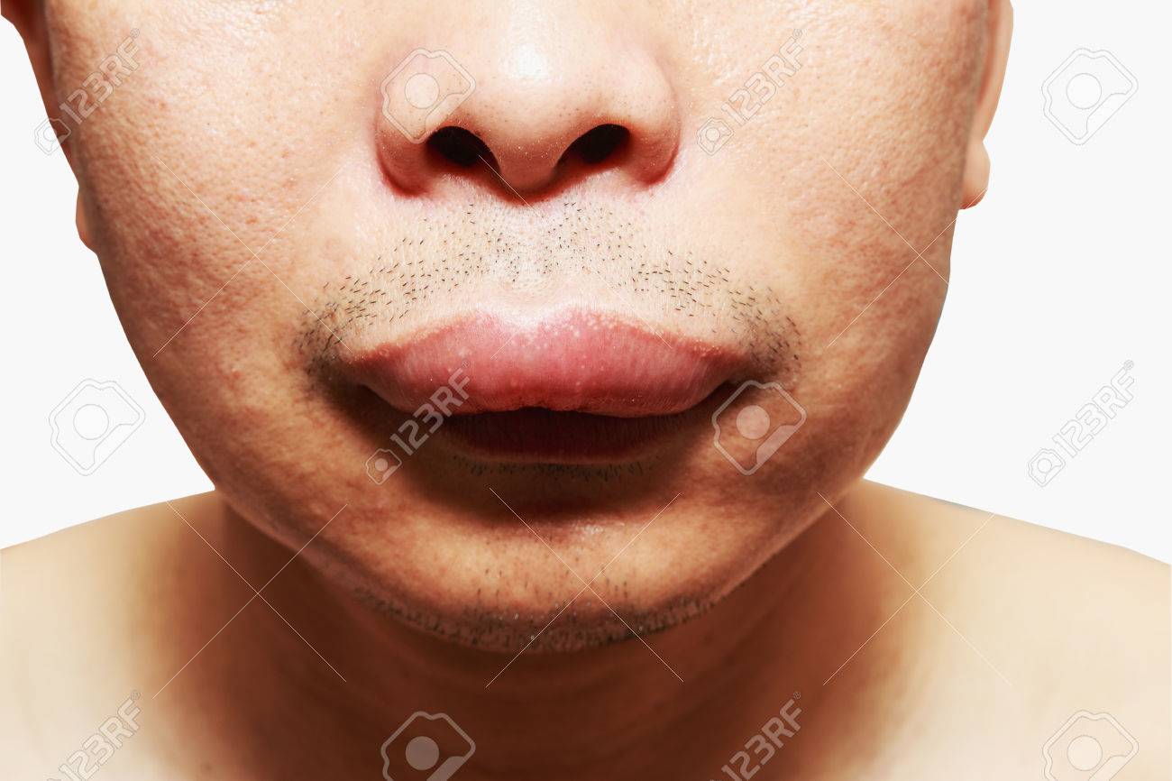 The Skin Around The Mouth Caused By An Allergic Reaction To Medication Stock Photo Picture And Royalty Free Image Image 56264609