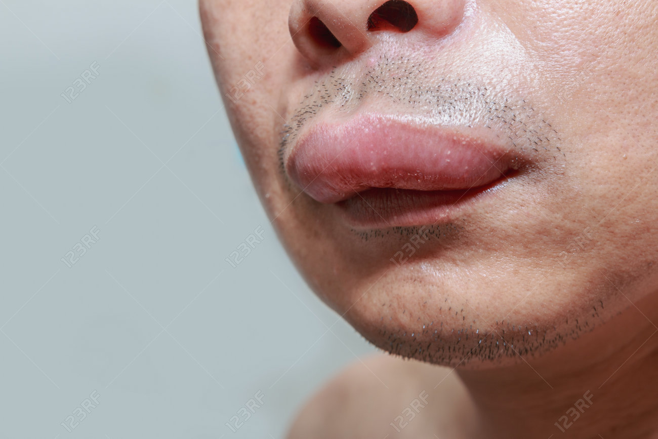 The Skin Around The Mouth Caused By An Allergic Reaction To Medication Stock Photo Picture And Royalty Free Image Image 60655445