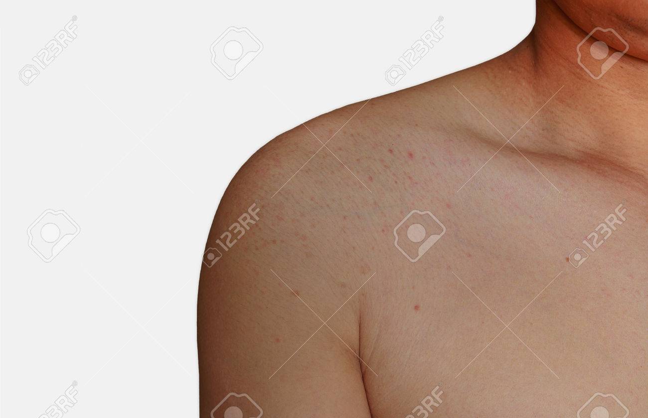 Man Avec Le Problème De La Dermatite Des éruptions Cutanées Les Allergies Région De Lépaule éruption - 