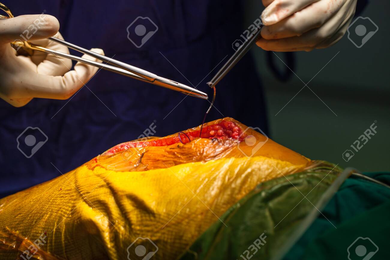 Team of doctor working at operating room in hospital. Surgeon perform total knee replacement surgery. Incision was made on patient 's knee in the case of osteoarthritis.Medical and orthopedic concept. - 127892902 Team of doctor working at operating room in hospital. Surgeon perform total knee replacement surgery. Incision was made on patient 's knee in the case of osteoarthritis.Medical and orthopedic concept. - 127892902
