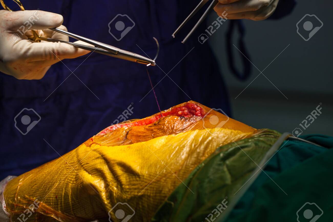 Team of doctor working at operating room in hospital. Surgeon perform total knee replacement surgery. Incision was made on patient 's knee in the case of osteoarthritis.Medical and orthopedic concept. - 127893739 Team of doctor working at operating room in hospital. Surgeon perform total knee replacement surgery. Incision was made on patient 's knee in the case of osteoarthritis.Medical and orthopedic concept. - 127893739