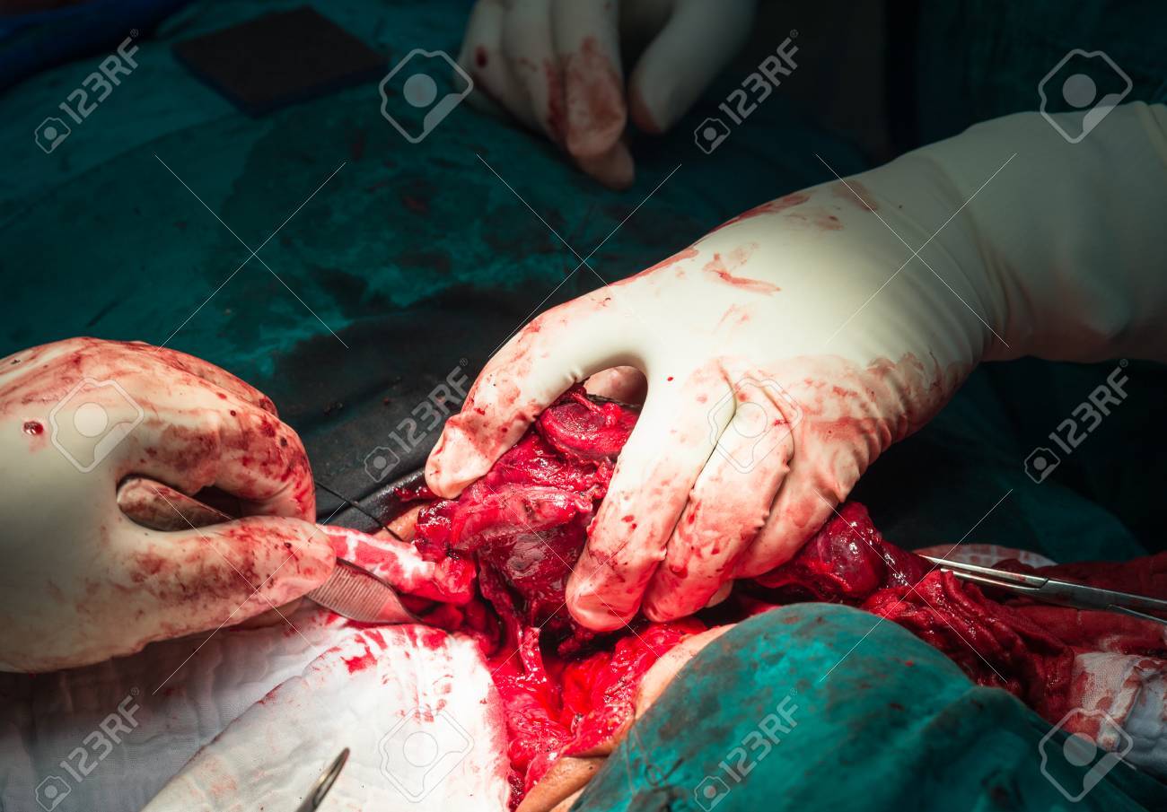 total thyroidectomy stock photo picture and royalty free image