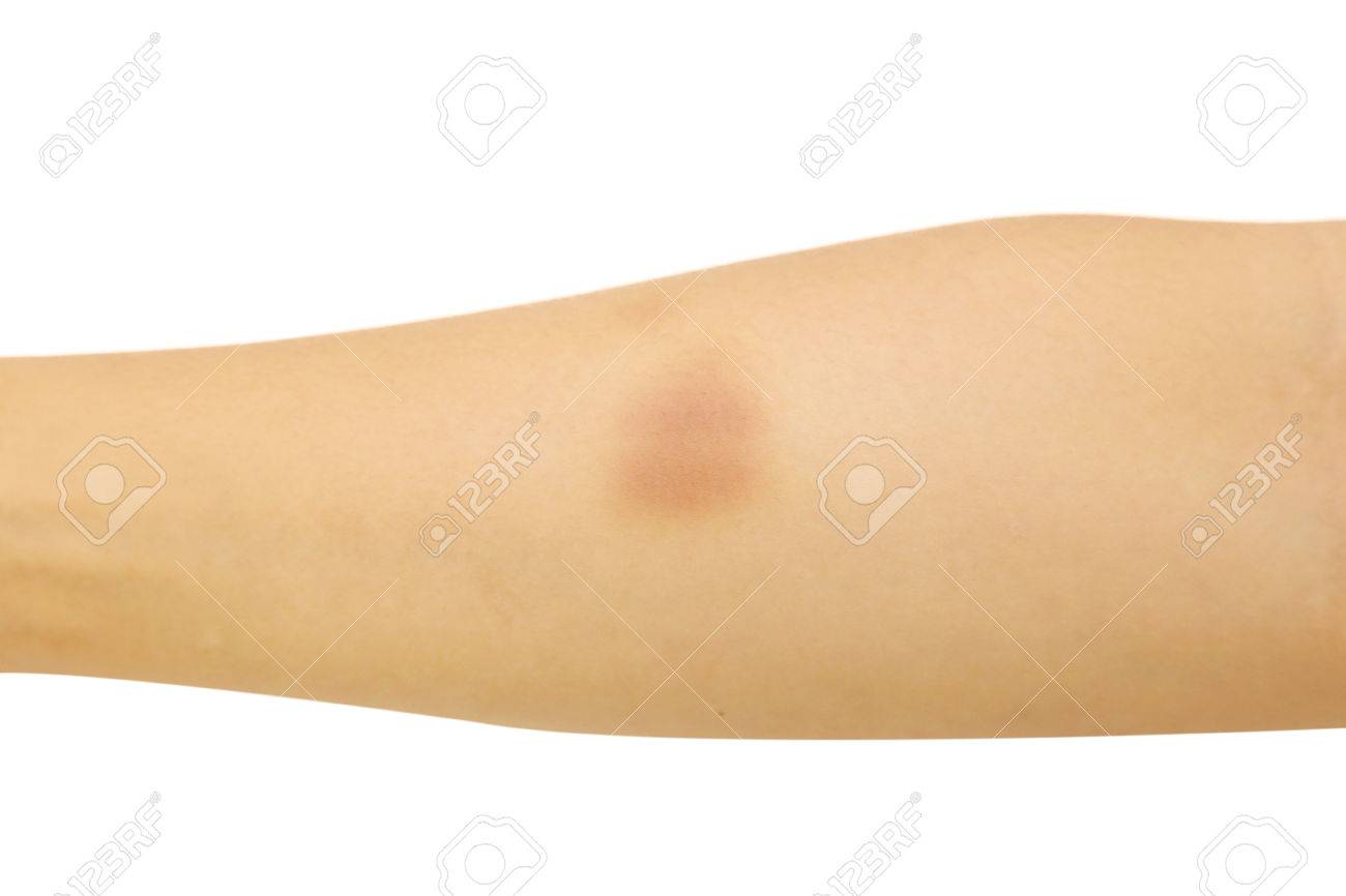 白い背景で傷ついた腕を分離 の写真素材 画像素材 Image