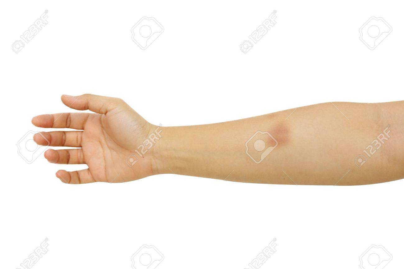 白い背景で傷ついた腕を分離 の写真素材 画像素材 Image