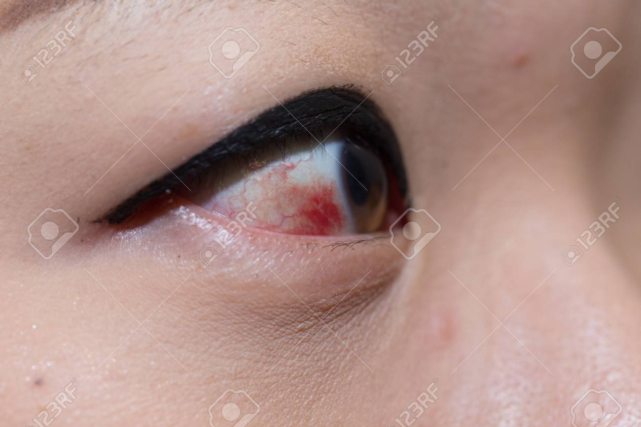 結膜下出血または眼の血管の骨折を有する眼傷を負った女性 の写真素材 画像素材 Image