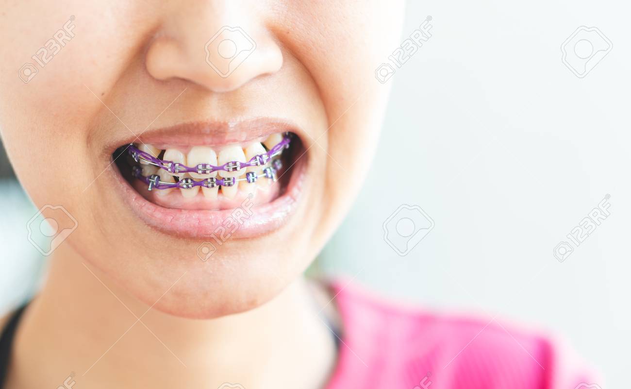 Women braces and is dirty, not beautiful. - 126260765 Women braces and is dirty, not beautiful. - 126260765