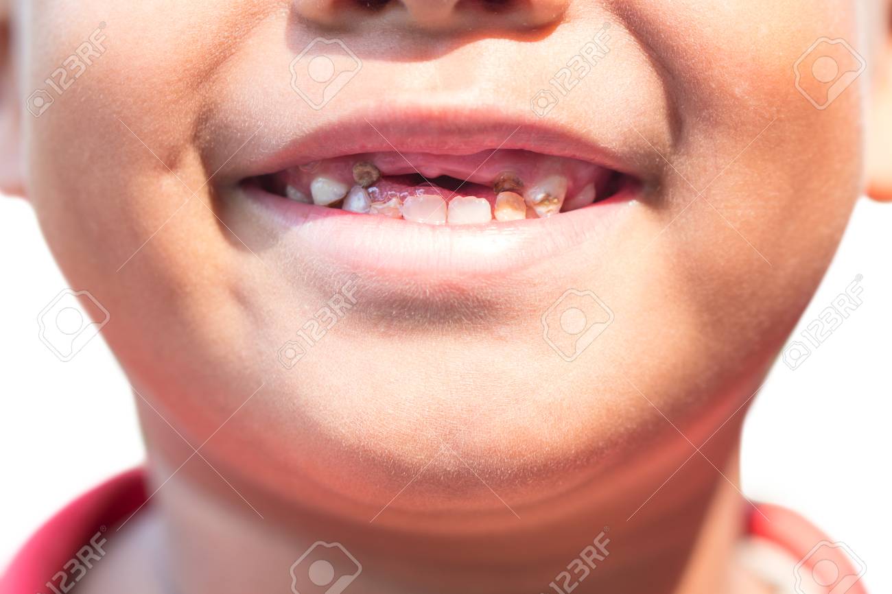 The boy with decayed baby teeth. - 126260767 The boy with decayed baby teeth. - 126260767