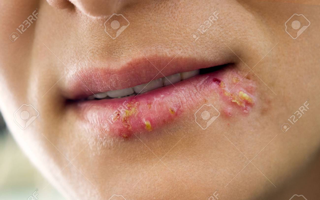 Pictures of Mouth and Tongue Disease Pictures of Mouth and Tongue Disease