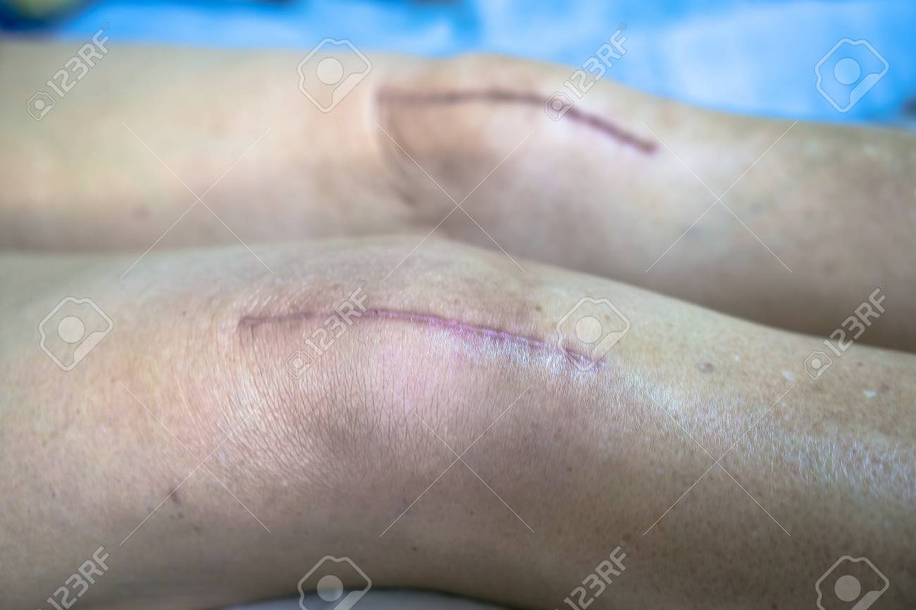 傷手術膝の手術 の写真素材 画像素材 Image