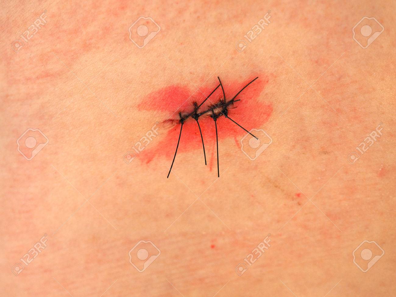 surgical wound with stitches and antiseptic iodine tincture stock