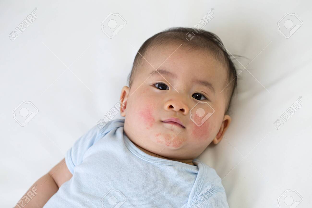 Asian baby boy lying on the bed and had a red rash on the face, Skin common rashes in newborn concept - 127171245 Asian baby boy lying on the bed and had a red rash on the face, Skin common rashes in newborn concept - 127171245