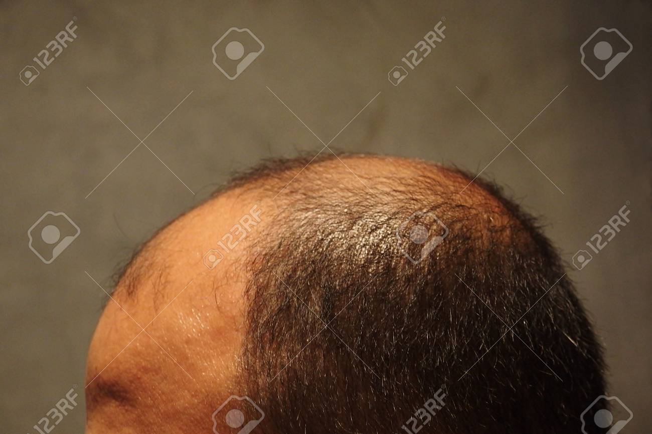 Hair Loss in Women Causes and Treatments for Every Age  GoodRx