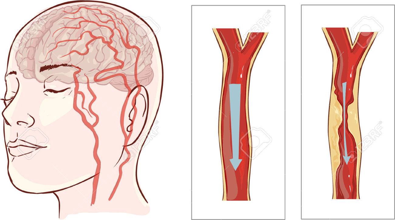 Vector Illustration Ofbrain Stroke. Cerebral Infarction 免版稅剪貼畫,向量插圖和庫存圖片.  Image 52745998